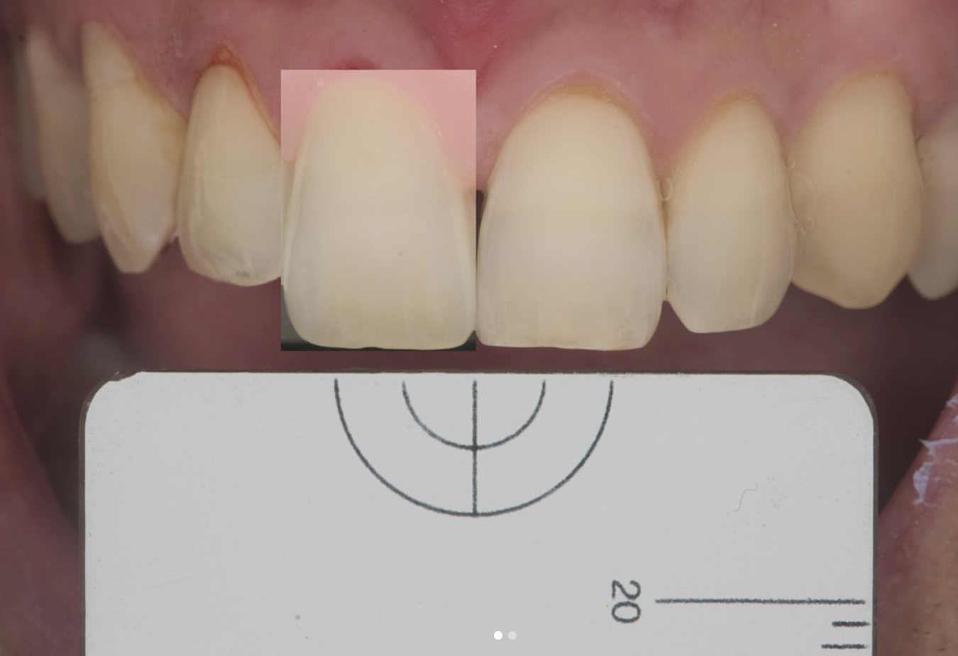 Shade Matching Case 02